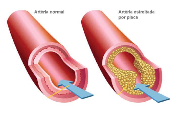 varizes-fatores-de-risco-e-prevencao